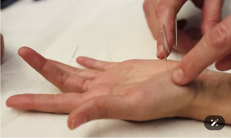 Punción de un punto de acupuntura en la mano